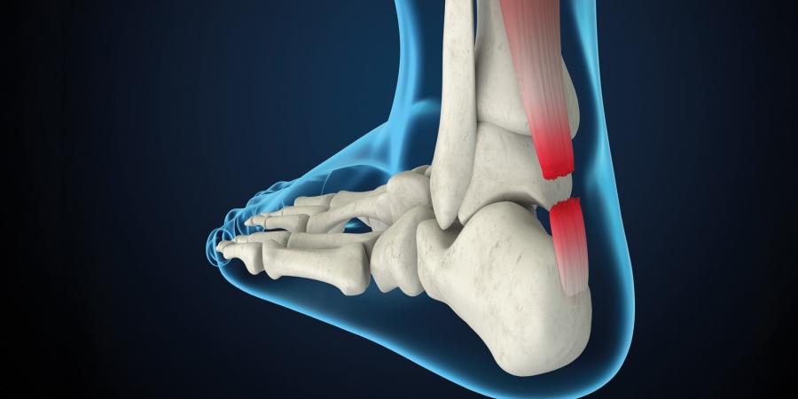 Stark und doch anfällig: Die Achillessehne